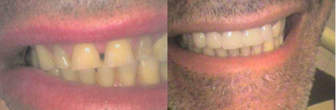 Ακίνητη προσθετική