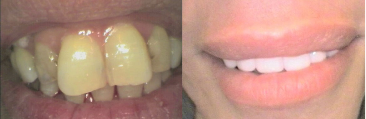 Ακίνητη προσθετική