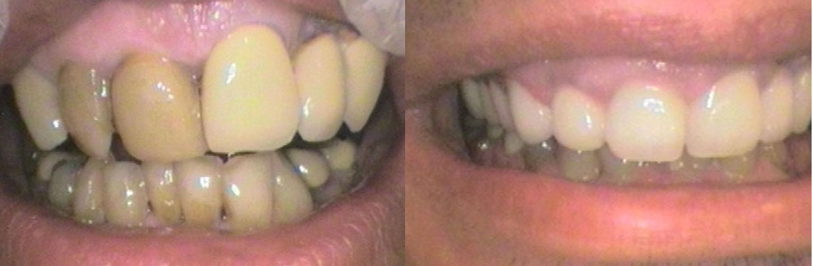 Ακίνητη προσθετική