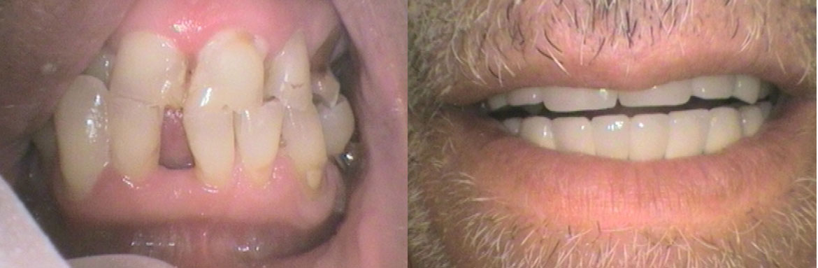 Ακίνητη προσθετική