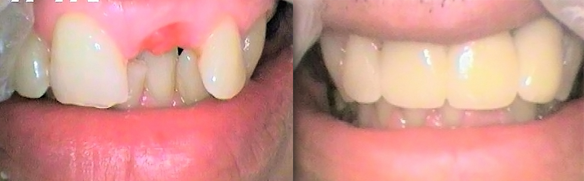 Ακίνητη προσθετική