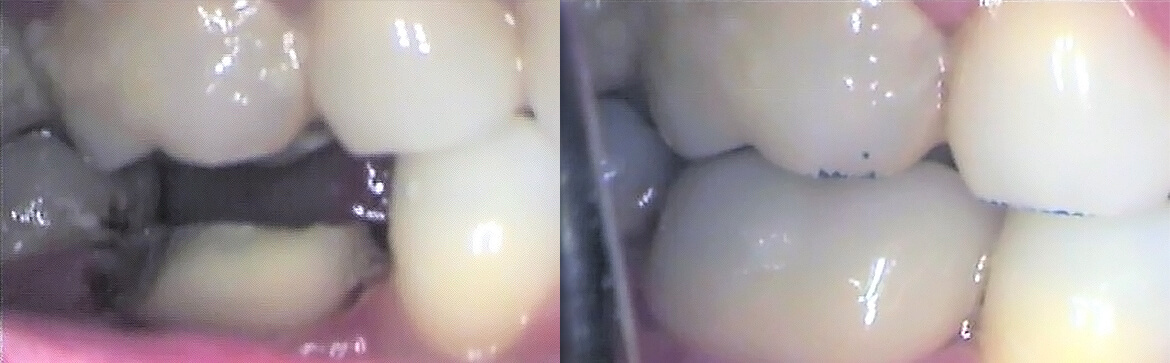 Ακίνητη προσθετική