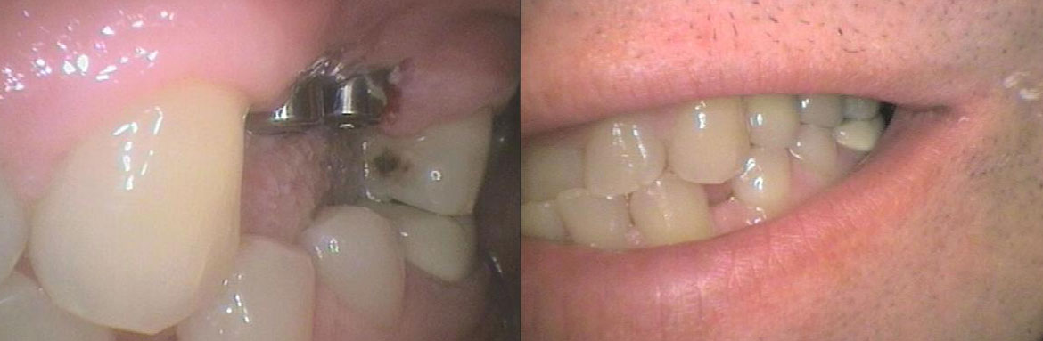 Εμφυτεύματα