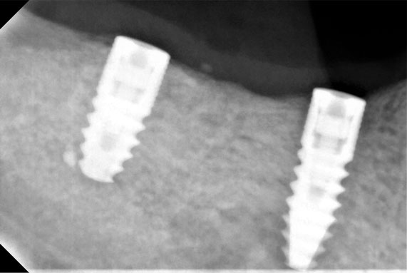 Εμφυτεύματα