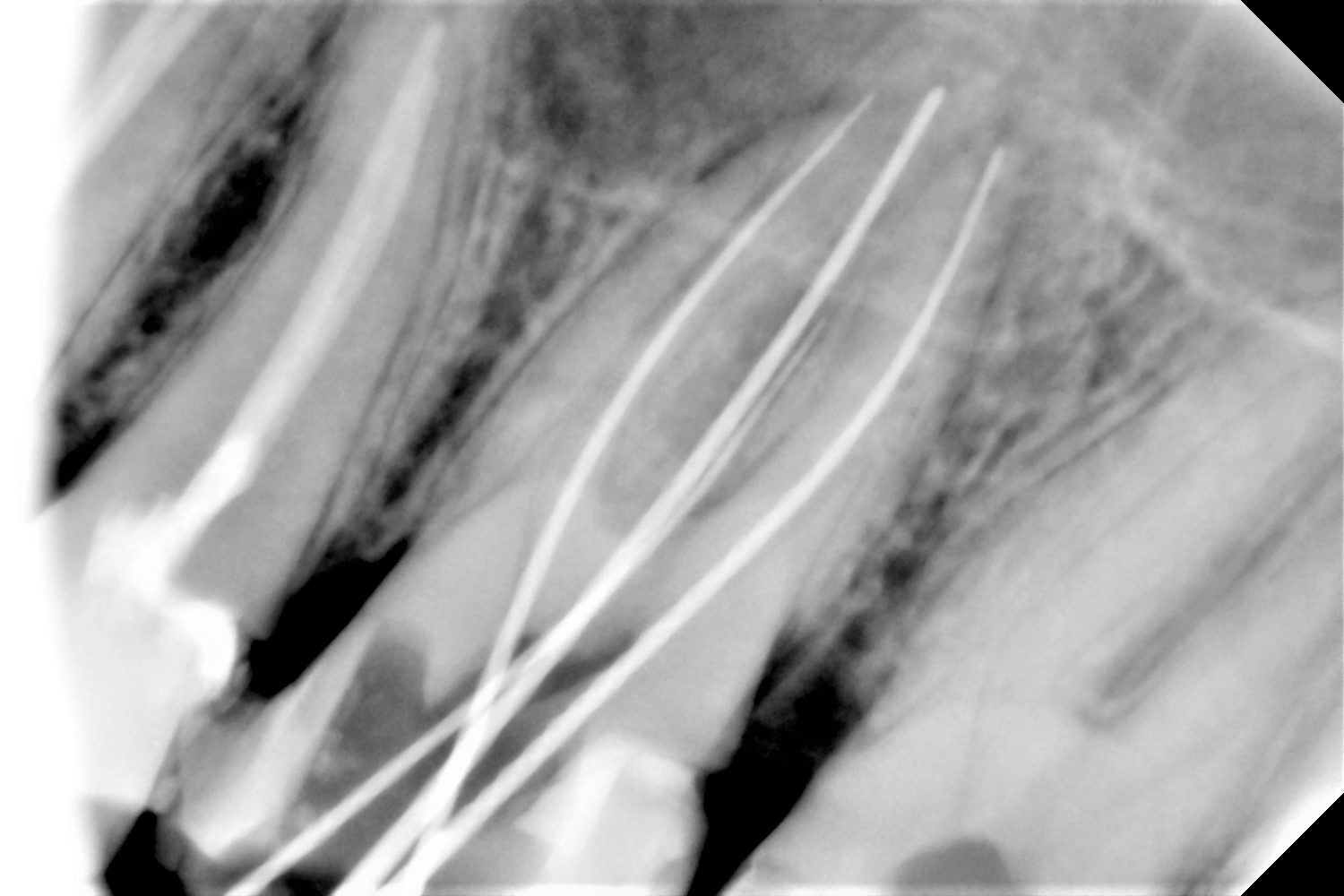 Ενδοδοντική Θεραπεία