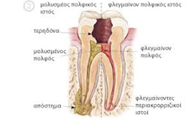 Ενδοδοντική Θεραπεία