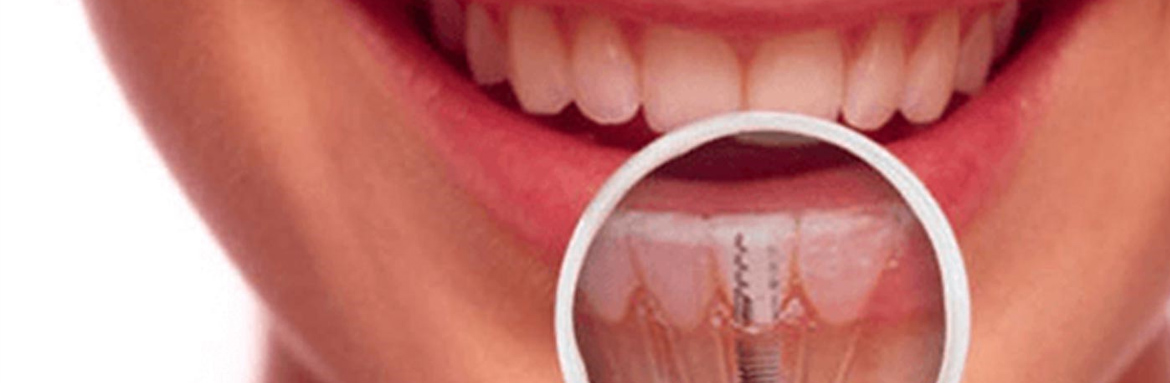 Εμφυτεύματα