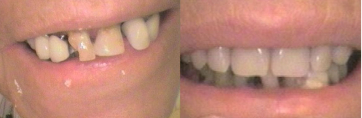 Κινητή προσθετική