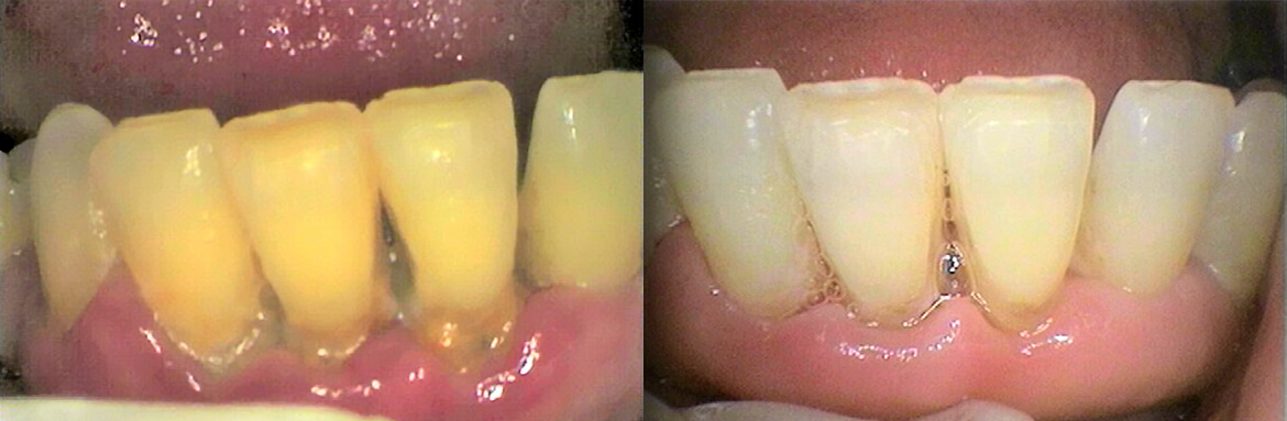 Πρόληψη-Καθαρισμός