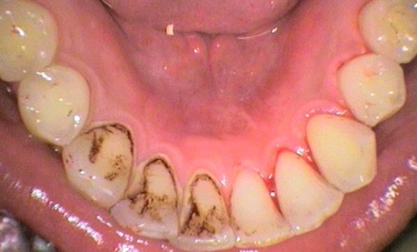 Πρόληψη-Καθαρισμός