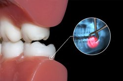 Εξακτική-χειρουργική εξαγωγή